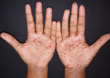 Sífilis mantém crescimento acelerado no Brasil