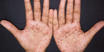 Sífilis mantém crescimento acelerado no Brasil