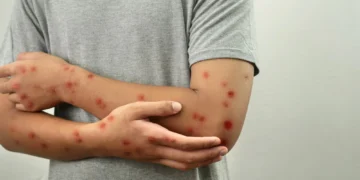 Suspeita de Mpox é descartada em Irecê